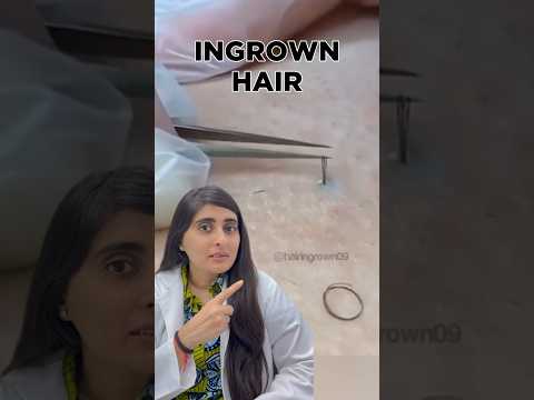Ingrown Hair Removal | Ingrown Hair Treatment | Ingrown Hair Dermatologist