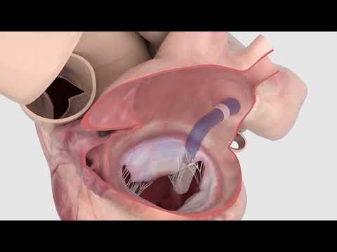 Maneuver with ease with the PASCAL Precision System