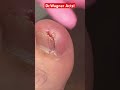 YOU MAY NOT BELIEVE THE SIZE OF THIS INGROWN TOENAIL Shorts