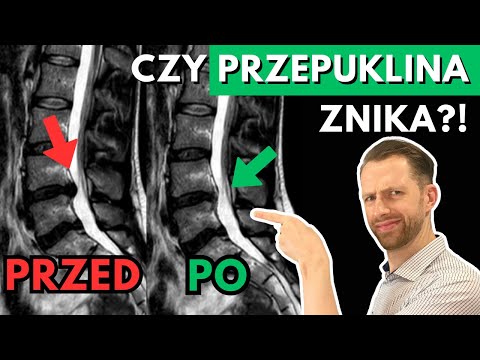 Can a hernia DISAPPEAR?! - exercises, discopathy, sciatica, lumbago, hernia