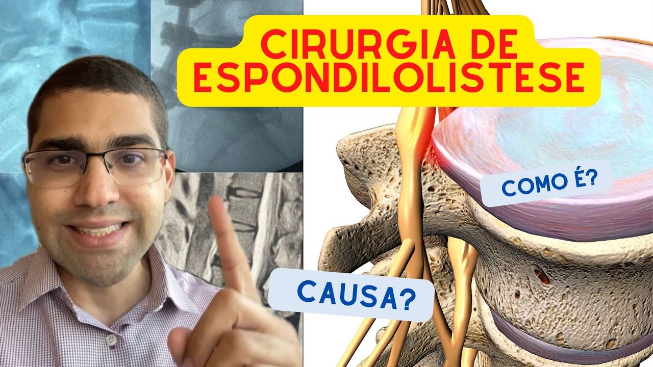 CIRURGIA DE ESPONDILOLISTESE