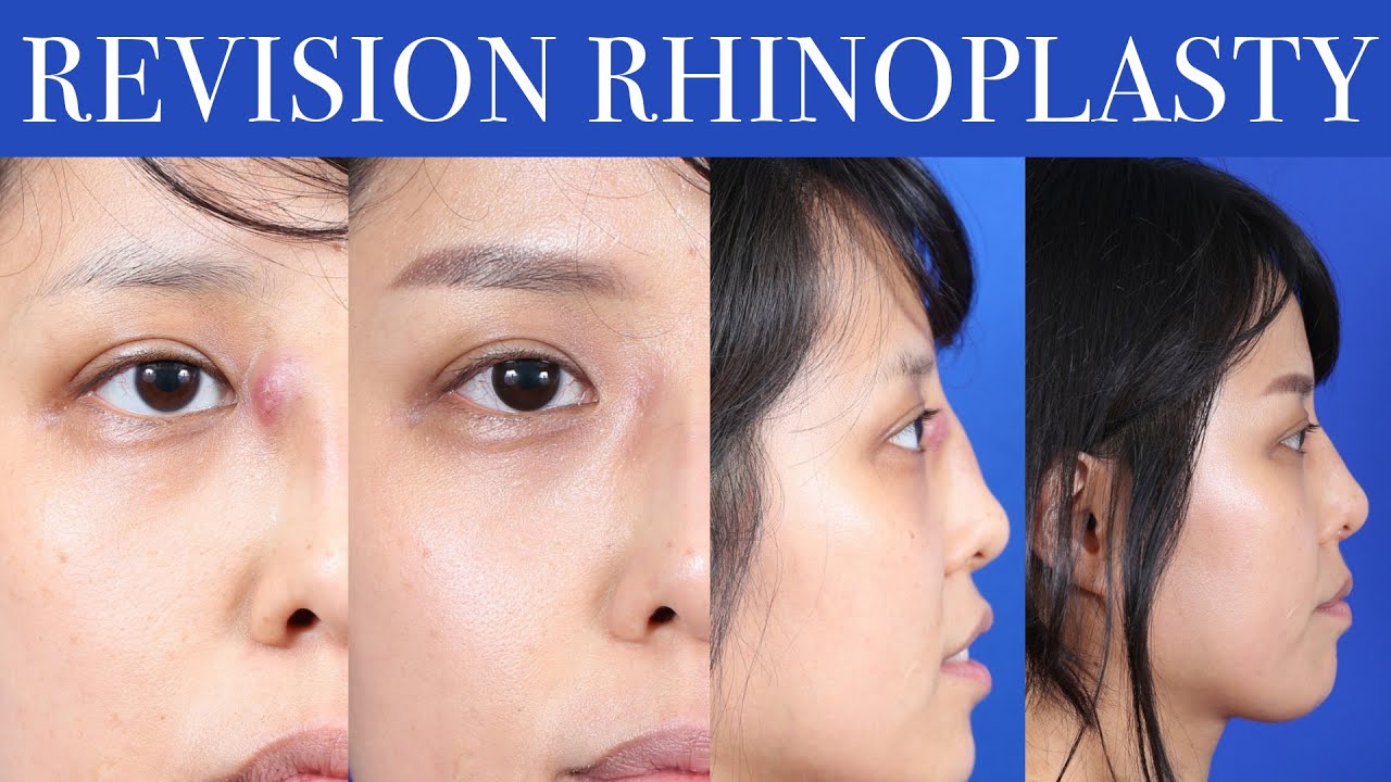 Revision Rhinoplasty NYC