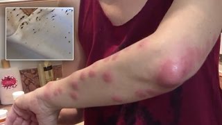 Woman Severely Bitten By Bedbugs At Atlantis Paradise Island Sues Resort