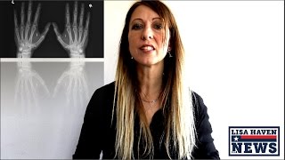 Has It Started? Mark of The BEAST In Europe—Employees Get Micro-Chipped! Then Have A Party!?