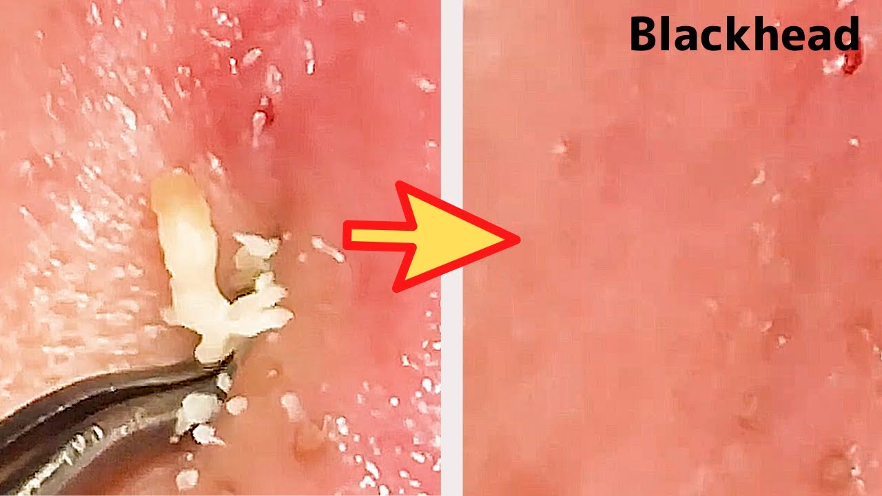 【角栓除去】グヂュっと出た！大量のニキビを芯出しするのって気持ちいい／Blackhead Removal Show