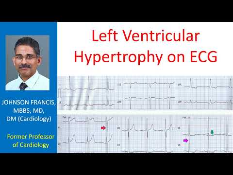 Left Ventricular Hypertrophy on ECG
