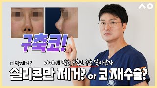 구축코 실리콘제거?or구축코재수술? 나에게 맞는 구축코수술방법 알아보기