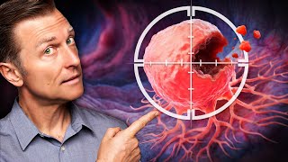 Advanced-Stage Colon Cancer Dies When You Do THIS