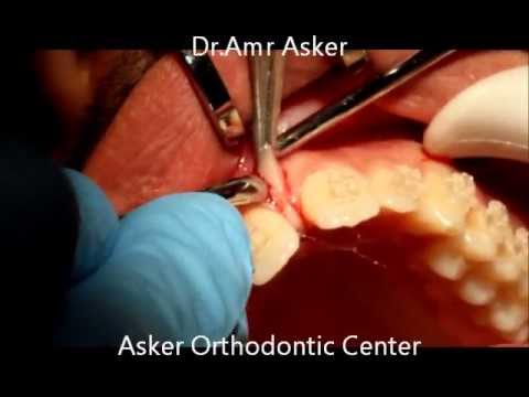 Frenectomy Labial - Midline Diastema Orthodontic Closure 
