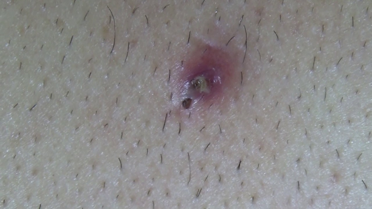 Blackhead Or Ingrown Hair Dr Pimple Popper Kansas City Comic Con