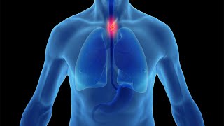 Heartburn, Reflux and GERD: Preventing the Progression to Esophageal Cancer