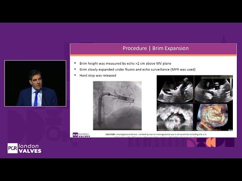 Shaping the treatment of mitral regurgitation with the Intrepid TMVR system - PCR London Valves 2025