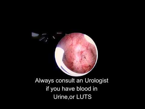  Urinary Bladder Cancer | Dr. S K Palash
