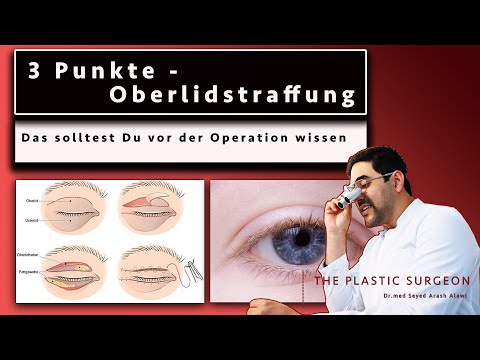 3 Dinge, die du vor einer Oberlidstraffung wissen musst - Erfahrungsbericht eines Experten
