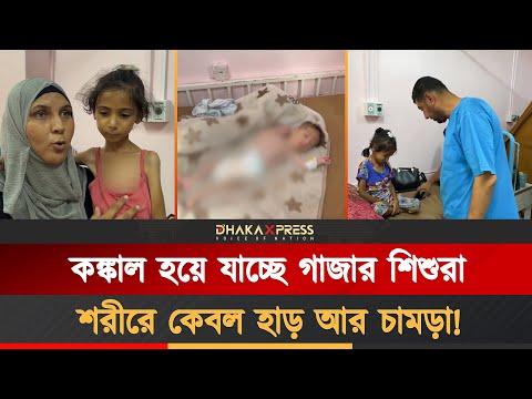 নির্জীব চোখ আর নড়তে না পারা শরীর: অপুষ্টিতে ধ্বংস হচ্ছে গাজার প্রজন্ম