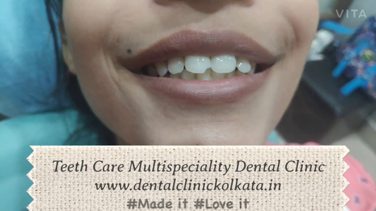 Best Cosmetic Dentist in Kolkata | Smile Designing Treatment in Kolkata
