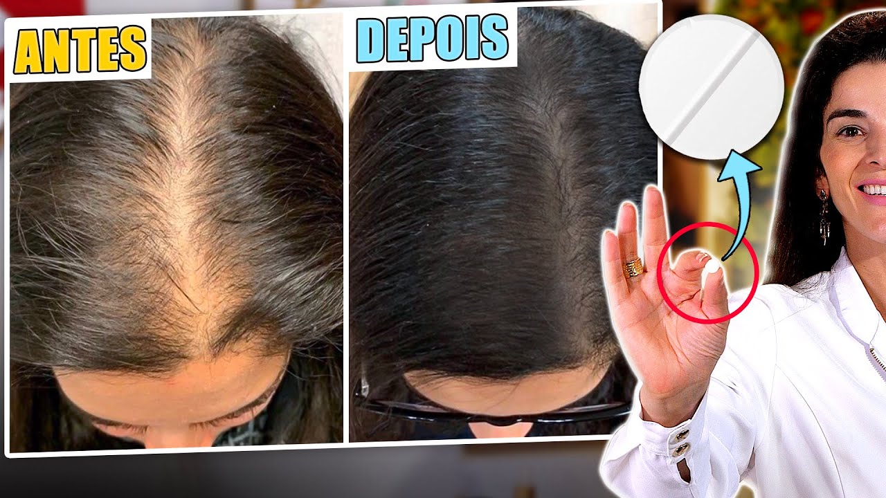 Amasse esse COMPRIMIDO e Use para Crescer Cabelo e Diminuir a Queda dos Cabelos!