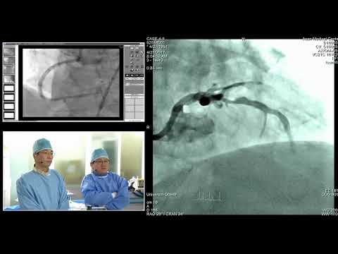 [TCTAP 2017] Coronary Symposium - Live Case & Lecture Session IV