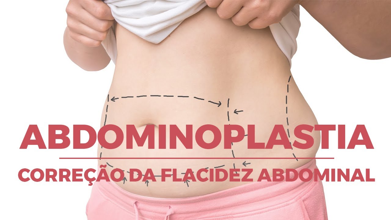 Abdominoplastia - acabe com a flacidez da barriga