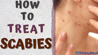 HOW TO TREAT SCABIES/scabies treatment at home