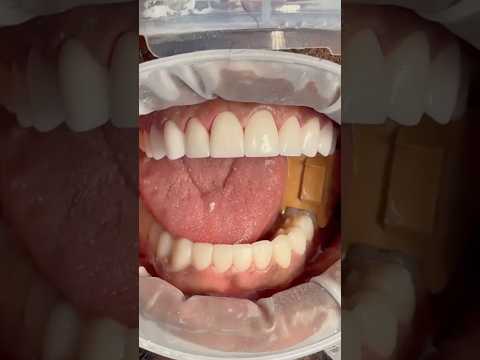 Porcelain Veneers in Turkey: Affordable, High-Quality Dental Care #dentatur #dentalveneersturkey