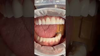 Porcelain Veneers in Turkey: Affordable, High-Quality Dental Care #dentatur #den
