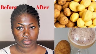 Remove dark spots in just 7 days with Potato | 100% Natural