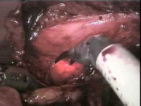 Partial Urinary Bladder Endoscopy With Bladder Diverticulum Removal (Robotically-Assisted And Laparoscopic) (1/3)