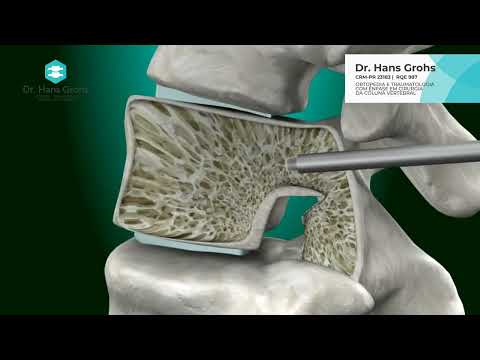 Dr. Hans Grohs - Cifoplastia