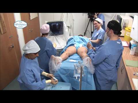Radiofrequency Ablation of the Great Saphenous Vein - treatment of Varicose Veins with RFiTT
