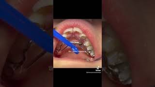 Así es como se activa el aparato Hyrax