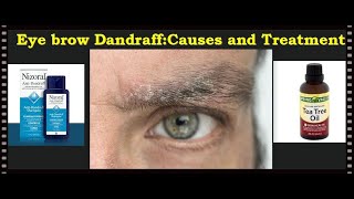 Eyebrow Dandruff: Causes And Treatment