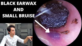 Bruised Ear Canal Cleared Of Black Ear Wax Plug