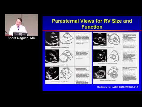Echocardiographic Assessment of RV Function