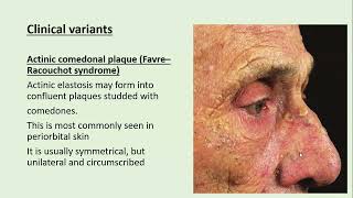 Lecture-147: Acquired disorders of Dermal Connective Tissues. Rook's Chapter 96.