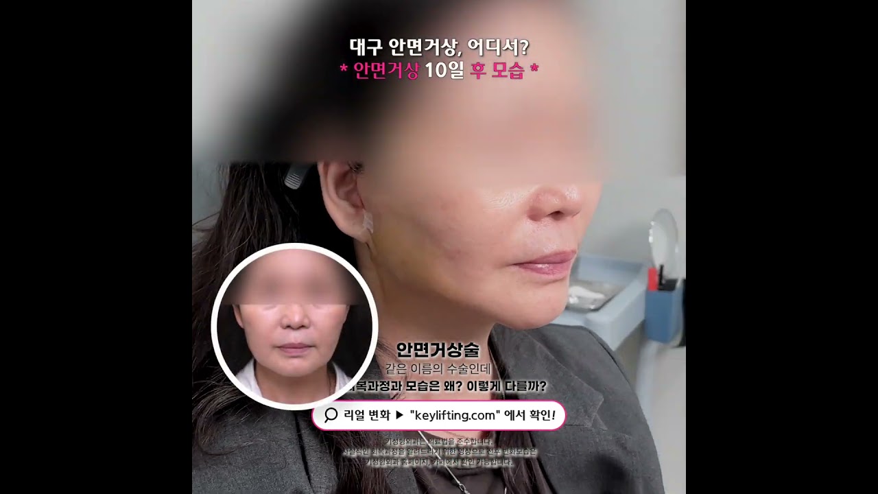 50대 수술후10일, 안면거상술