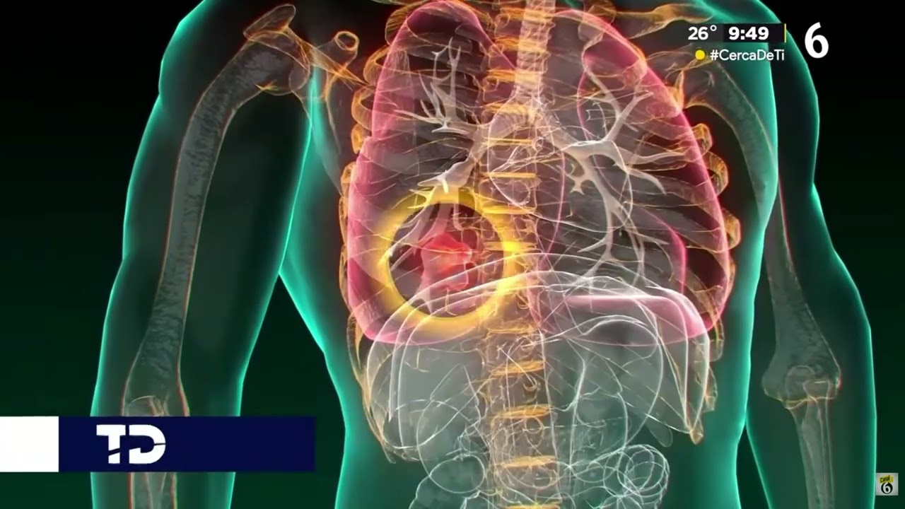 Nuevo León usa IA para detectar cáncer de pulmón en etapas iniciales