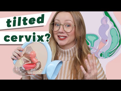 Using Menstrual Cups and Discs with a Tilted Cervix