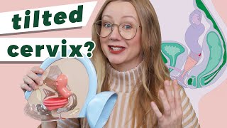 Using Menstrual Cups and Discs with a Tilted Cervix