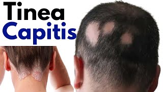 Tinea capitis symptoms treatment | Ringworm of scalp | tinea capitis scalp treatment