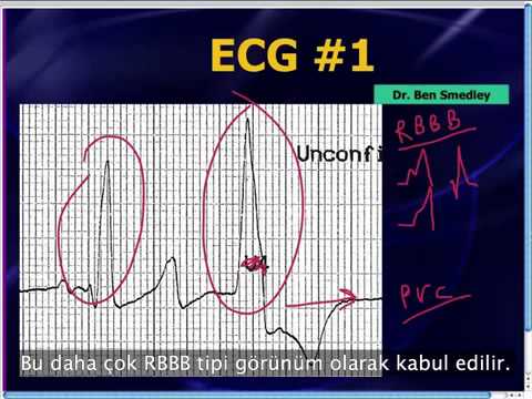Mattu EKG Vakası: Bradikardinin Ayırıcı Tanısı - 8 Temmuz 2013 (Türkçe Altyazılı)