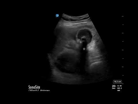 Gallbladder Ultrasound: Stones, Sludge & Murphy Sign Made Simple