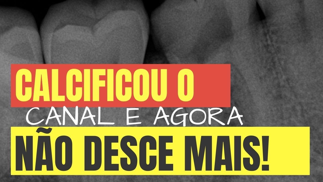 “O CANAL ESTAVA DESCENDO ANTES, MAS AGORA CALCIFICOU! O QUE EU FAÇO?” - ENDOLOVERS QUICK TIP