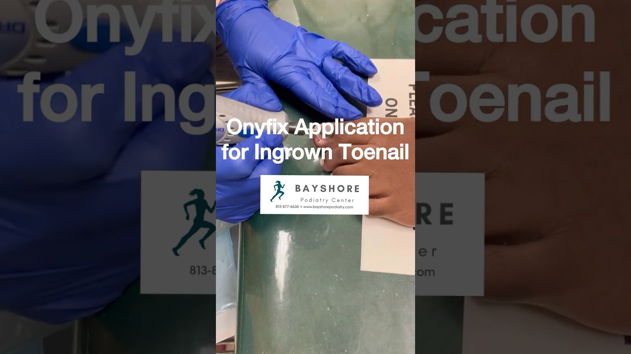 Onyfix® Application for Ingrown Toenail Relief