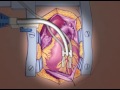 Off Pump Bypass Animation