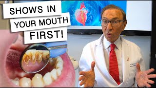 5 Diseases That Show Signs In Your Mouth