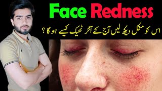 Face Redness Treatment | How to Get Rid of Skin Redness | Beauty Facts