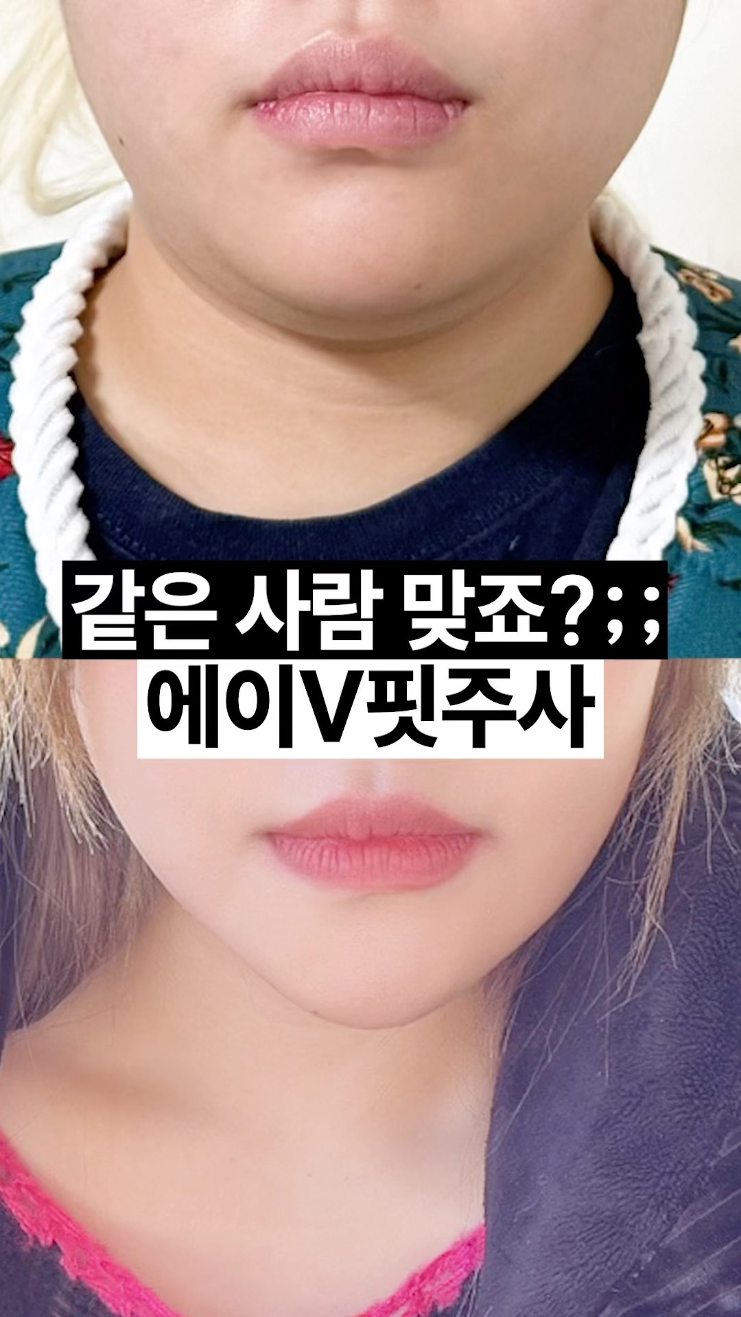 안 보이던 목선 에이빼주사로 해결한 후기 🩵