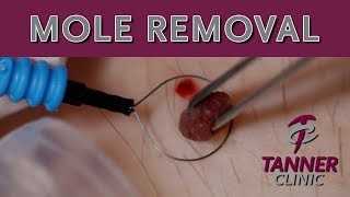 Mole Removal Plus After Care Information with Scott Beckstead, DO at our Farmington Tanner Clinic