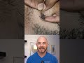 Derm Reacts To INSANELY Hairy Extraction Dermreacts Doctorreacts Extraction
